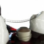 Kako vam zobni implantati izboljšajo življenje in zdravje