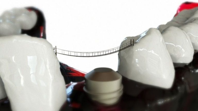 Kako vam zobni implantati izboljšajo življenje in zdravje