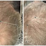 Izpadanje las: kako do vidno gostejših in močnejših las